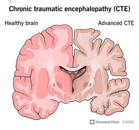 Chronic Traumatic Encephalopathy