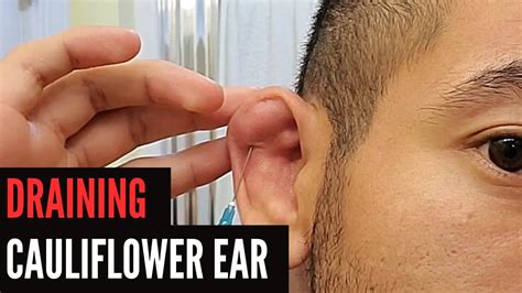 Draining Cauliflower Ear