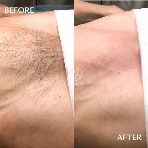 Laser Hair Removal Before and After