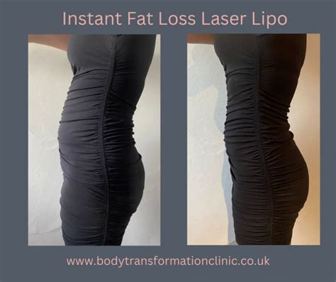 Laser Lipo Before and After
