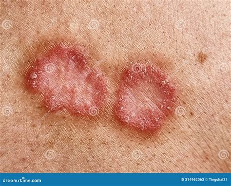 Ringworm Skin Infection