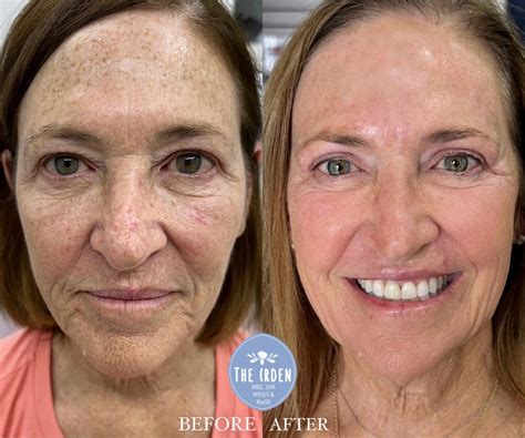 Skin Rejuvenation Before and After