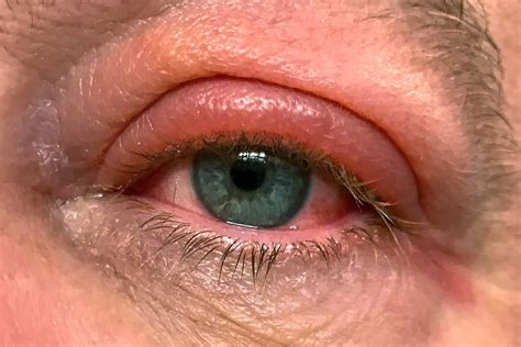Tyson's swollen eye
