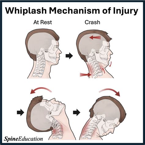 Whiplash Mechanism